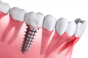 Does Medicare Cover Dental Implants